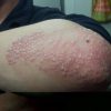 Psoriasis