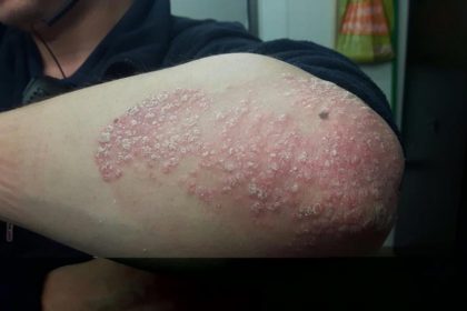 Psoriasis