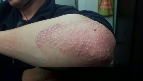 Psoriasis