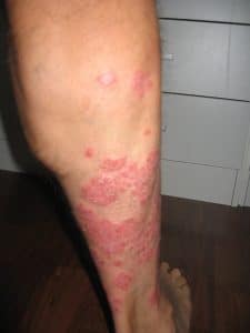 Foto 1 psoriasis