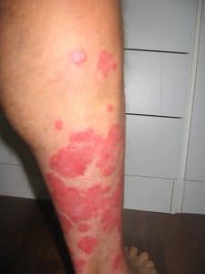 Foto 2 psoriasis