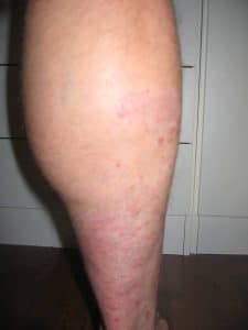 Foto 3 psoriasis